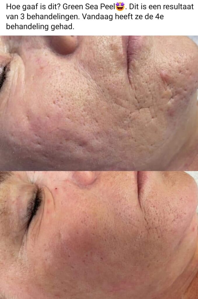 resultaat Green sea Peel